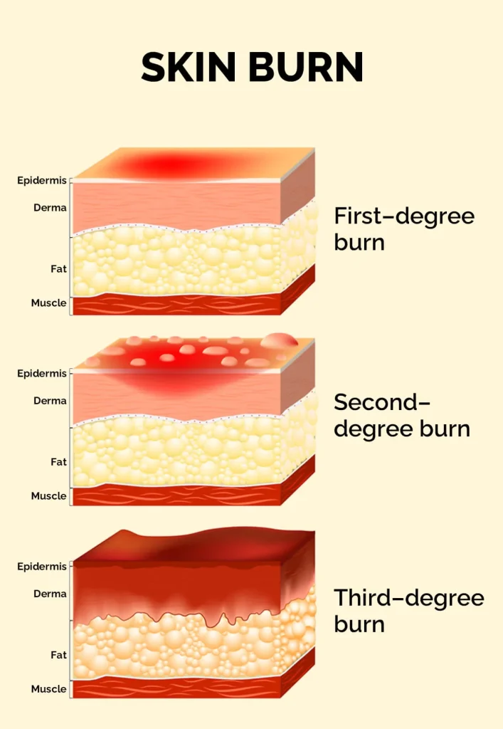 Burn Wound Care: Degrees, Treatment & Advanced Dressings